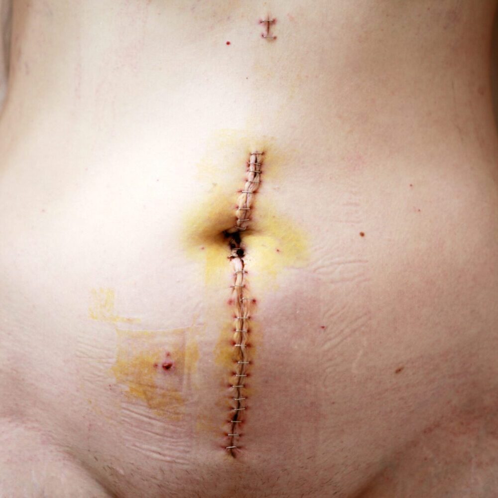 Bildausschnitt eines Bauches nach einer Operation